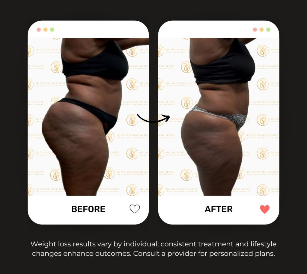 be you esthetic suites med spa in brooklyn ny offering ozempic botox semaglutide glp-1 ultrasonic cavitation red light therapy brazilian butt lift vacuum therapy wood therapy iv therapy body contouring body sculpting. Glp-1 treatments, semaglutide, weight management, appetite control