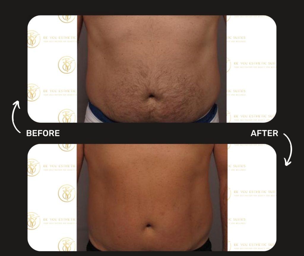 Learn about laser hair removal preparation with these pre-treatment care and post-treatment tips to give you optimal results. Laser hair removal is offered at Be You Esthetic Suites, brooklyns premier med spa offering a wide range of services at an affordable price. body sculpting, botox, chemical peel, facials, glp-1, lip fillers, lymphatic drainage massage med spa, red light therapy, semaglutide