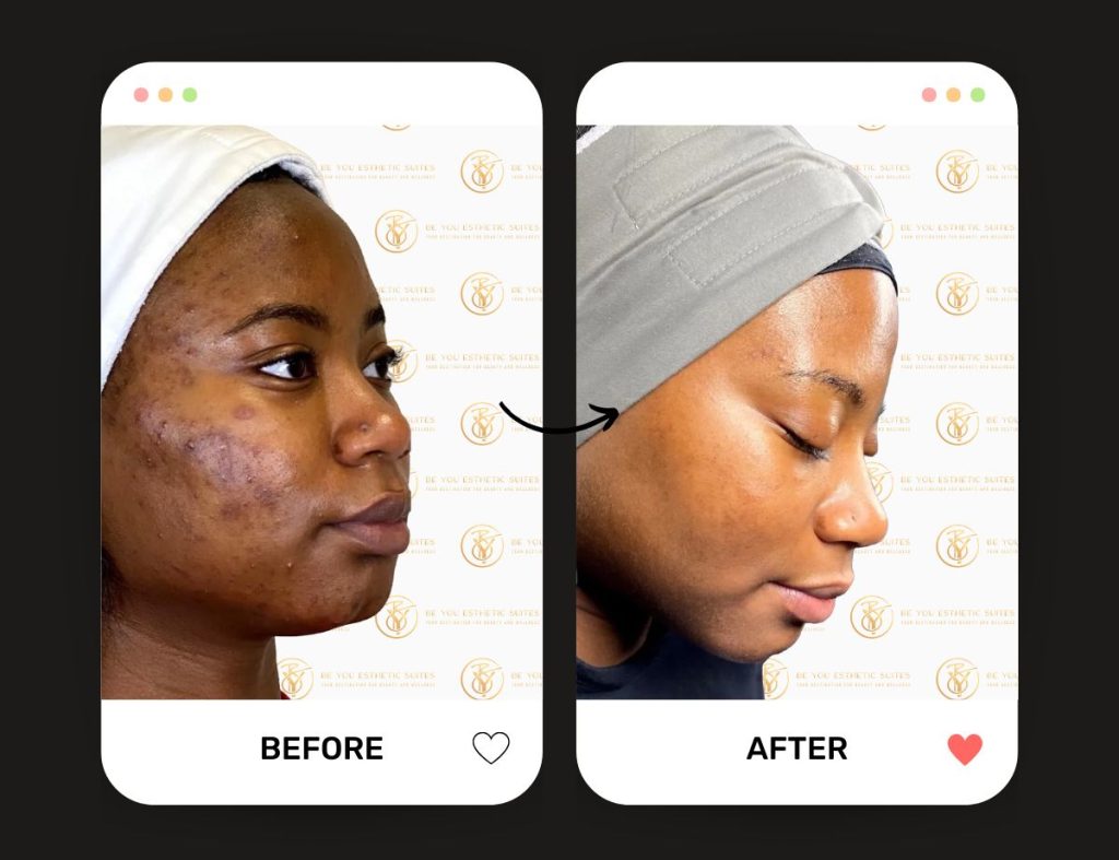 Learn about Be You Esthetic Suites signature facial, the Be You Facial. Professional skincare, skin Maintenance, glow enhancement, and so much more from the facial. Be You Esthetic Suites is the premier med spa in Brooklyn, best facials in Brooklyn, chemical peels in Brooklyn. brooklyn skin treatments