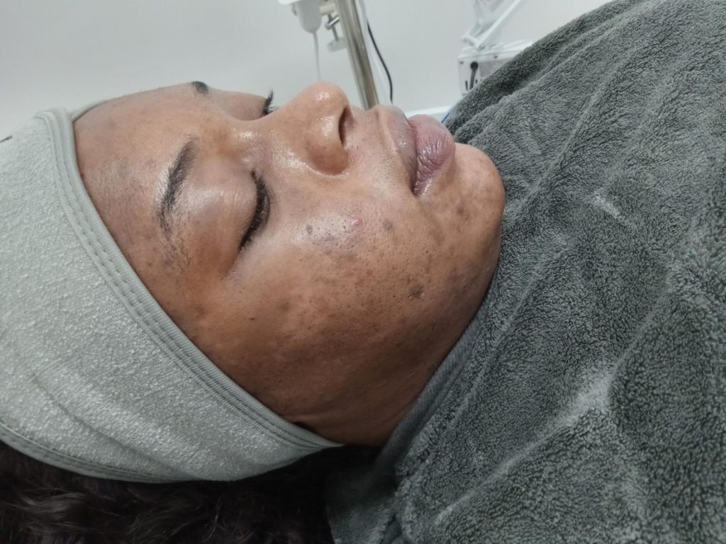 effective acne treatments for all skin types in Brooklyn NY at Be You Esthetic Suites offering many other skin treatments and med spa treatments. Red light therapy and microdermabrasion, facial treatments.