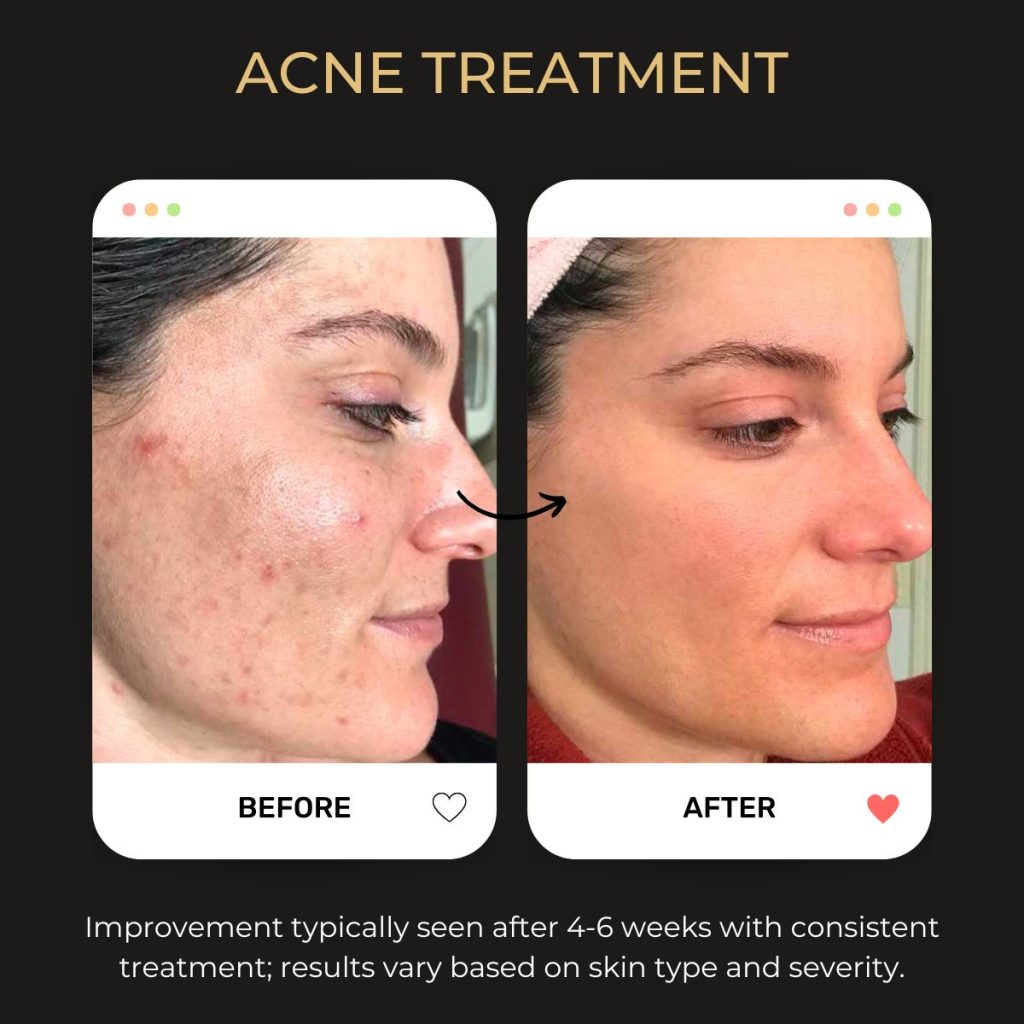 Brooklyn face treatments, treatment session targeting skin texture and hyperpigmentation using professional exfoliation methods.