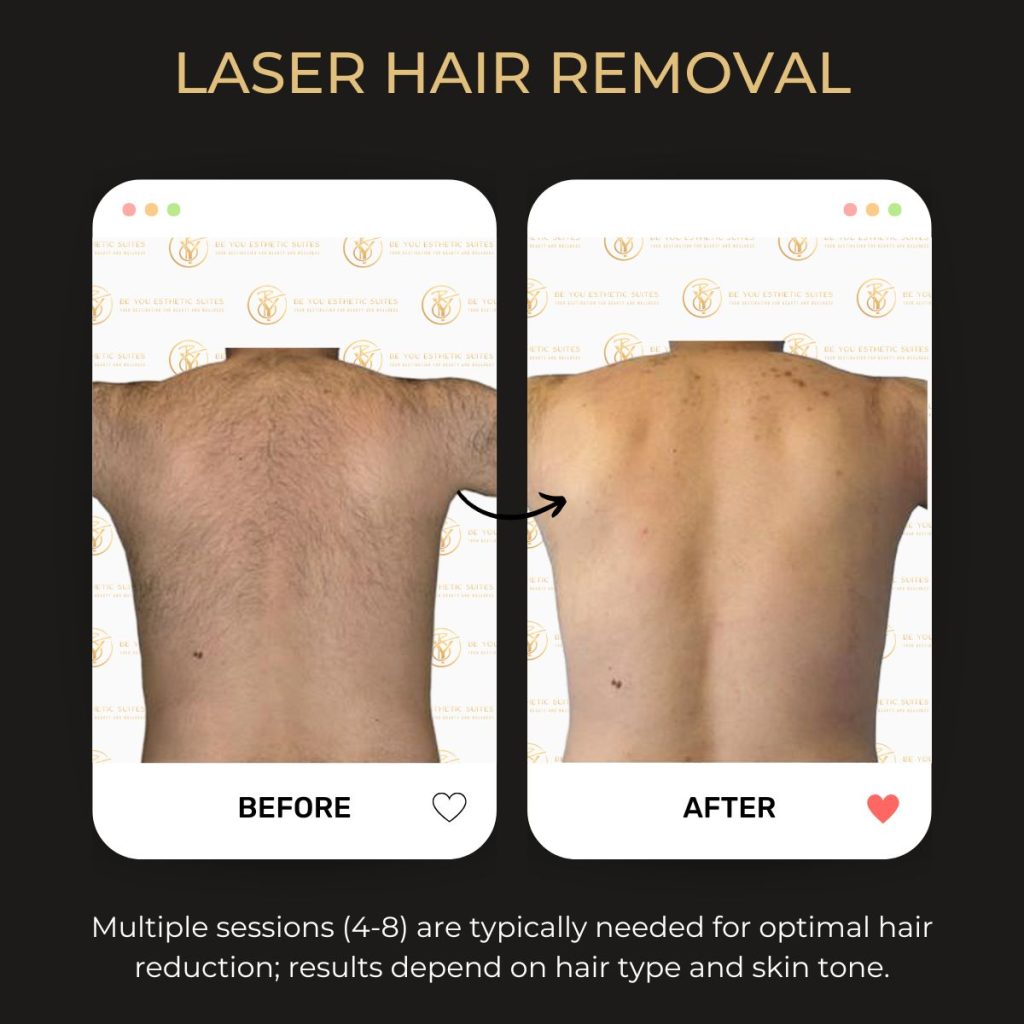 Laser Hair Removal Before & After - 4