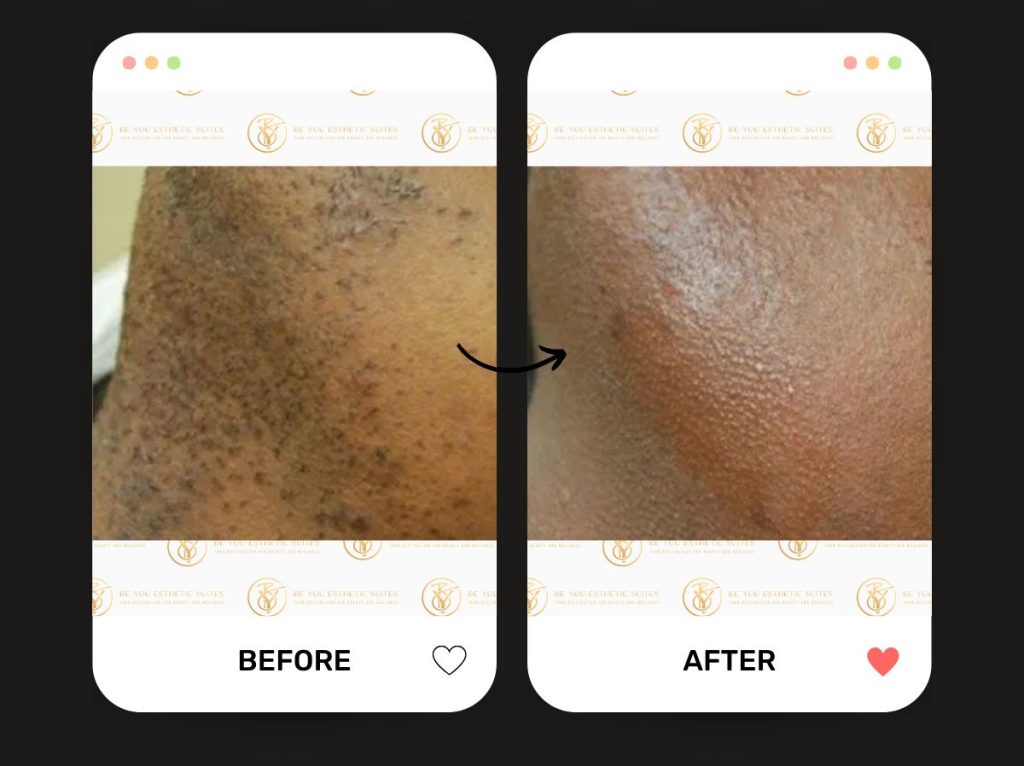 Understand the laser hair removal comparison to waxing alternatives. See how laser hair removal is the pain-free options with better long-term savings. Contact Be You Esthetic Suites in Brooklyn for a session for an affordable price. med spa, body sculpting, botox, chemical peel, facials, glp-1, lip fillers, lymphatic drainage massage, red light therapy, semaglutide