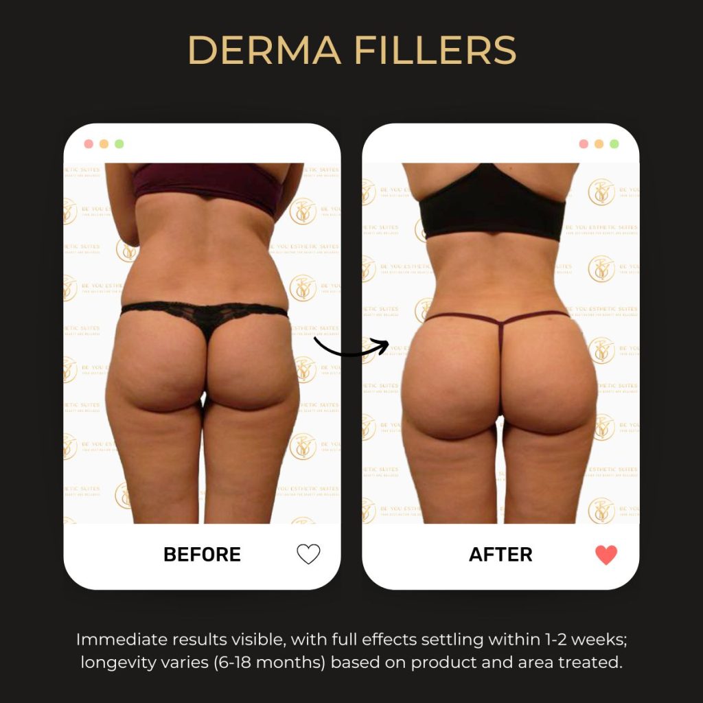 Before and after image of curve enhancement achieved through Body Fillers Enhancement, a non-surgical option for body contouring.