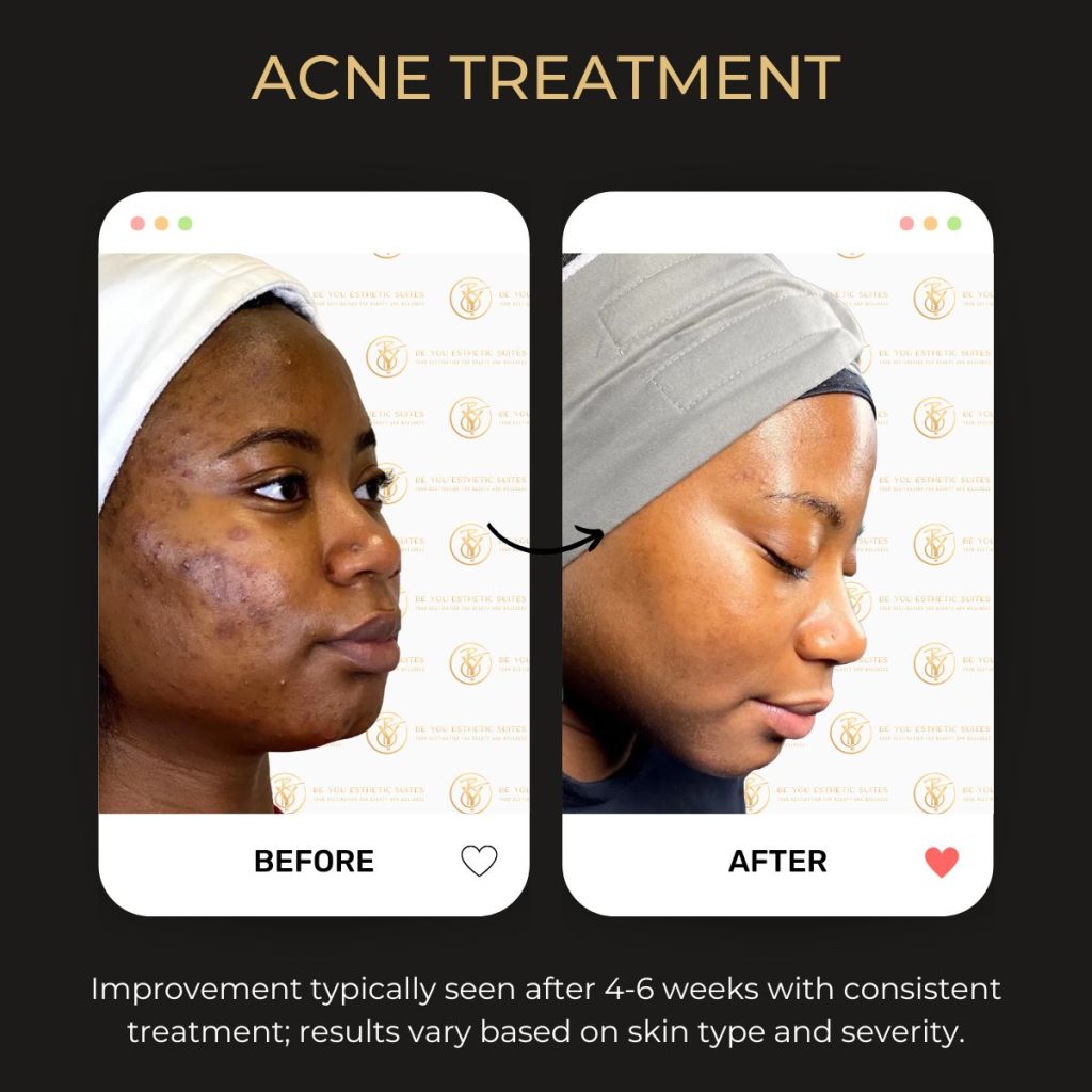 Acne Treatment Before & After - 2