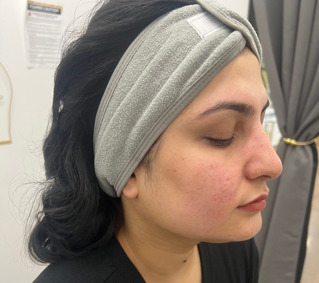 Microdermabrasion facial in Brooklyn, Be You Esthetic Suites is the premier choice for Brooklyn skincare for deep exfoliation and skin rejuvenation. Brooklyn med spa, brooklyn chemical peel, facials in Brooklyn, red light therapy in brooklyn. 