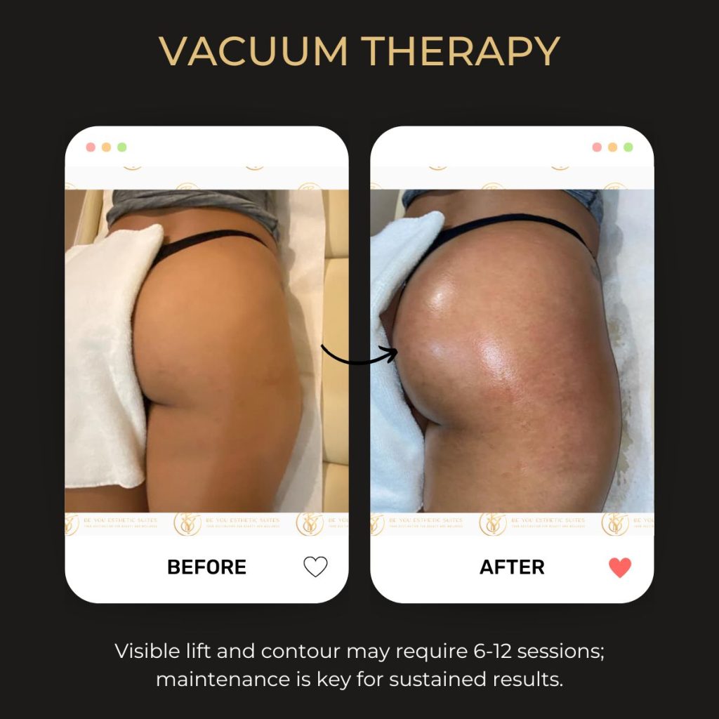 Before and after image of curve enhancement achieved through Body Fillers Enhancement, a non-surgical option for body contouring.