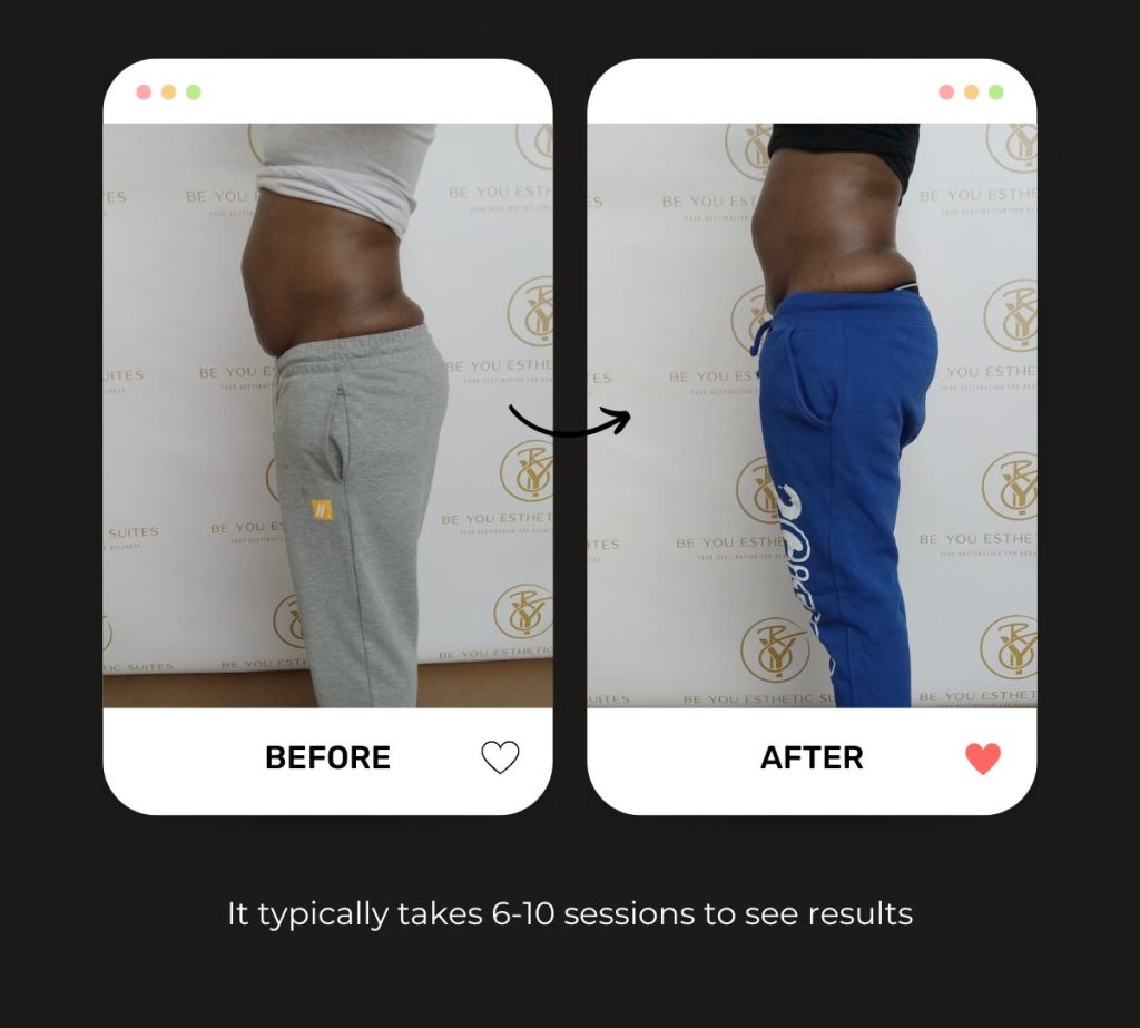 Explore how Ultrasonic Cavitation is the best liposuction alternative in Brooklyn, NY. This treatment requires no recovery period for clients. Be You Esthetic Suites is the top rated med spa in Brooklyn. Offering facials in Brooklyn, Brooklyn body sculpting, Ultrasonic cavitation in Brooklyn, Brooklyn Med spa, red light therapy treatments in Brooklyn, massages in Brooklyn.