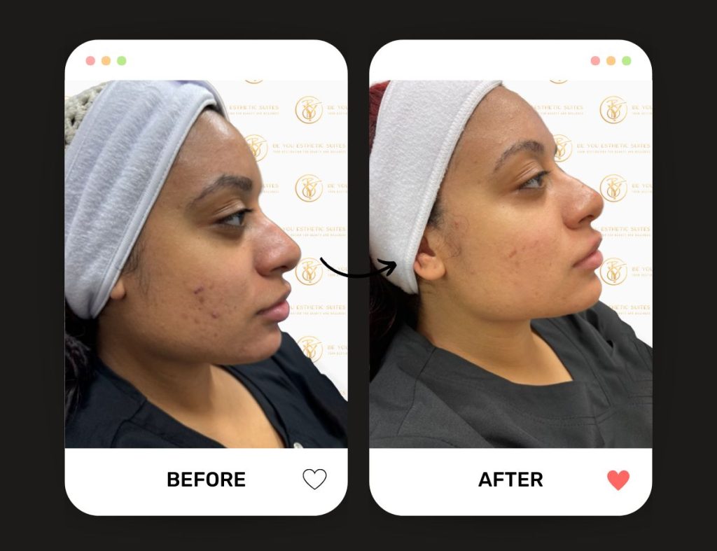 Learn about Be You Esthetic Suites signature facial, the Be You Facial. Professional skincare, skin Maintenance, glow enhancement, and so much more from the facial. Be You Esthetic Suites is the premier med spa in Brooklyn, best facials in Brooklyn, chemical peels in Brooklyn. brooklyn skin treatments