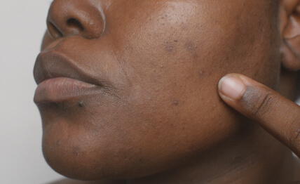 Acne Treatment Service