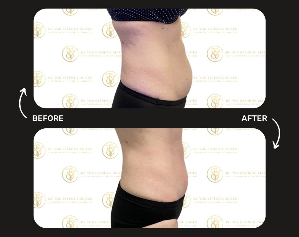 Body contouring options like ultrasonic cavitation and vacuum therapy in Brooklyn, Be You Esthetic Suites is the top rated med spa in Brooklyn offering non-surgical treatments. body contouring in brooklyn, body sculpting in brooklyn, facials in brooklyn, brooklyn chemical peels, vacuum therapy in brooklyn, ultrasonic cavitation in brooklyn