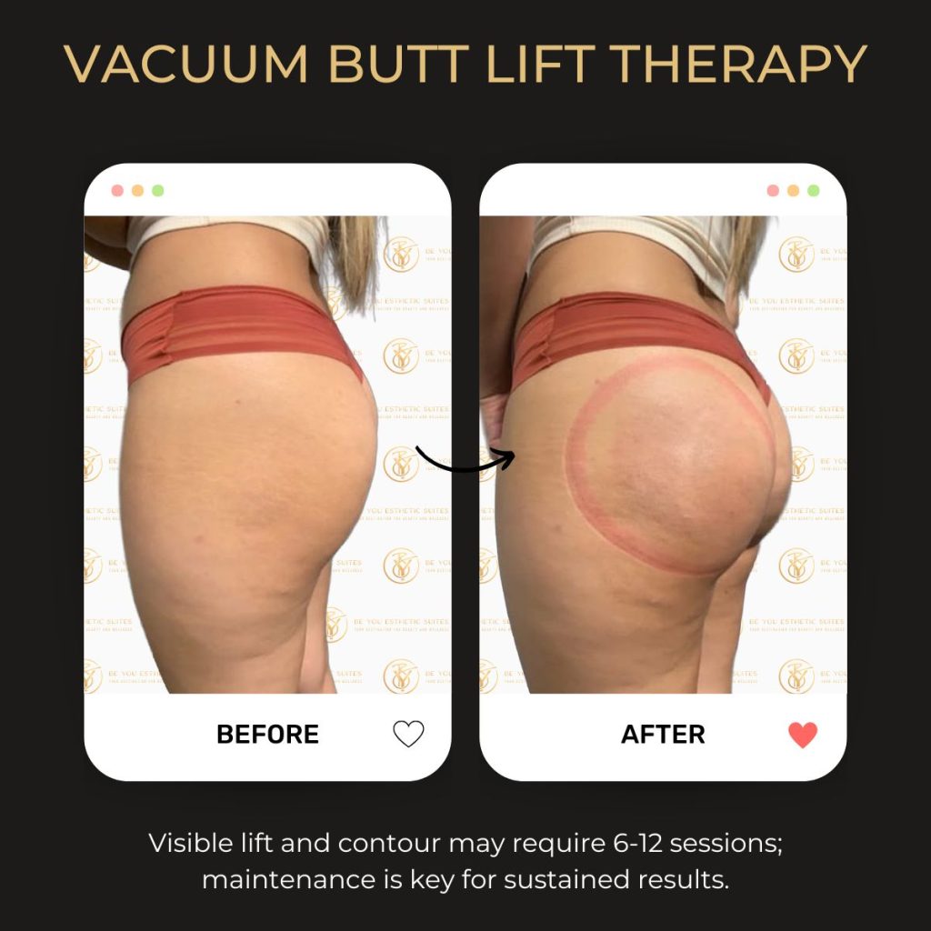 Non-surgical Vacuum Butt Lift treatment in progress, focused on enhancing curves through advanced contouring sessions.