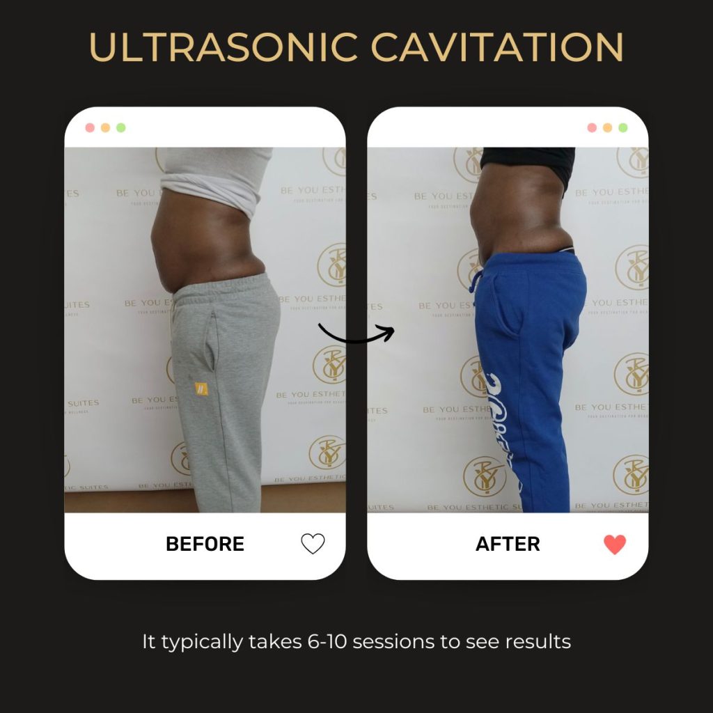 ULTRASONIC-CAVATION-Img