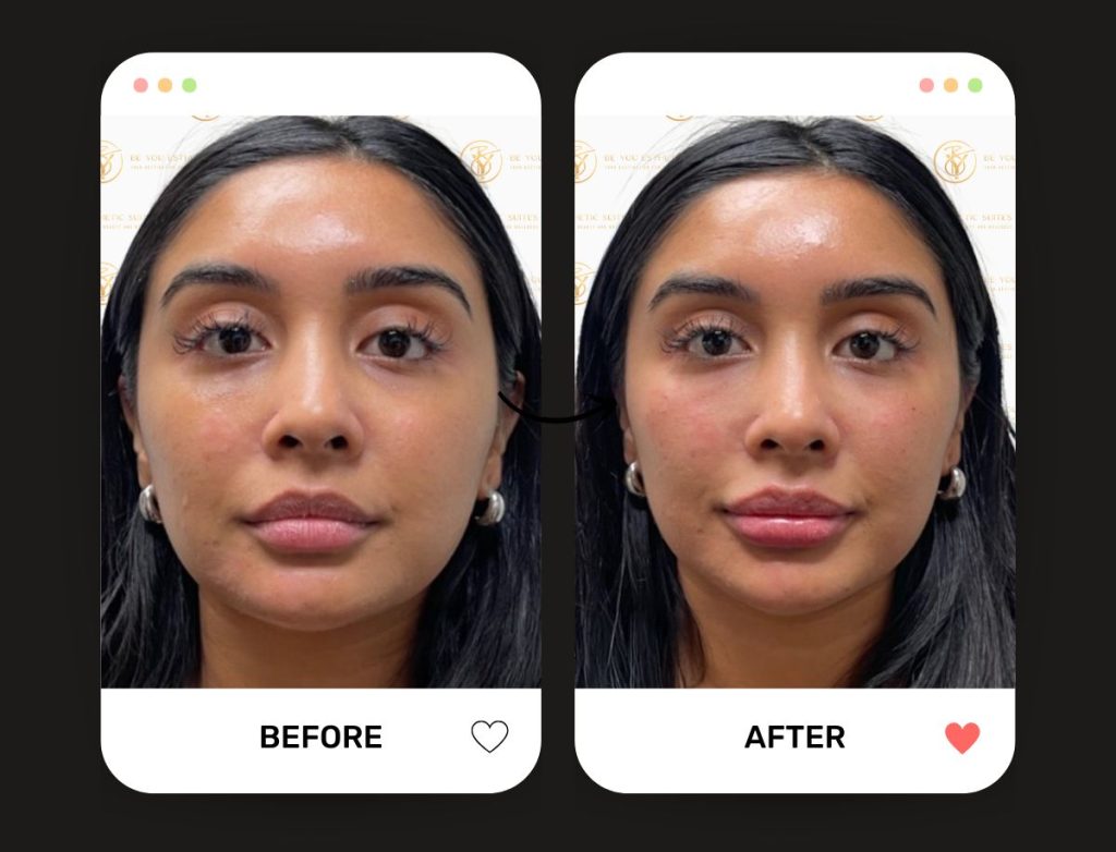10 things to learn about Brooklyn Body Fillers to get natural results and injectable treatments with buttock enhancement and other spots. Be You Esthetic Suites is the top rated med spa in Brooklyn for Body Fillers, Dermal Fillers in Brooklyn, body contouring in brooklyn, red light therapy in brooklyn, laser hair removal in brooklyn.
