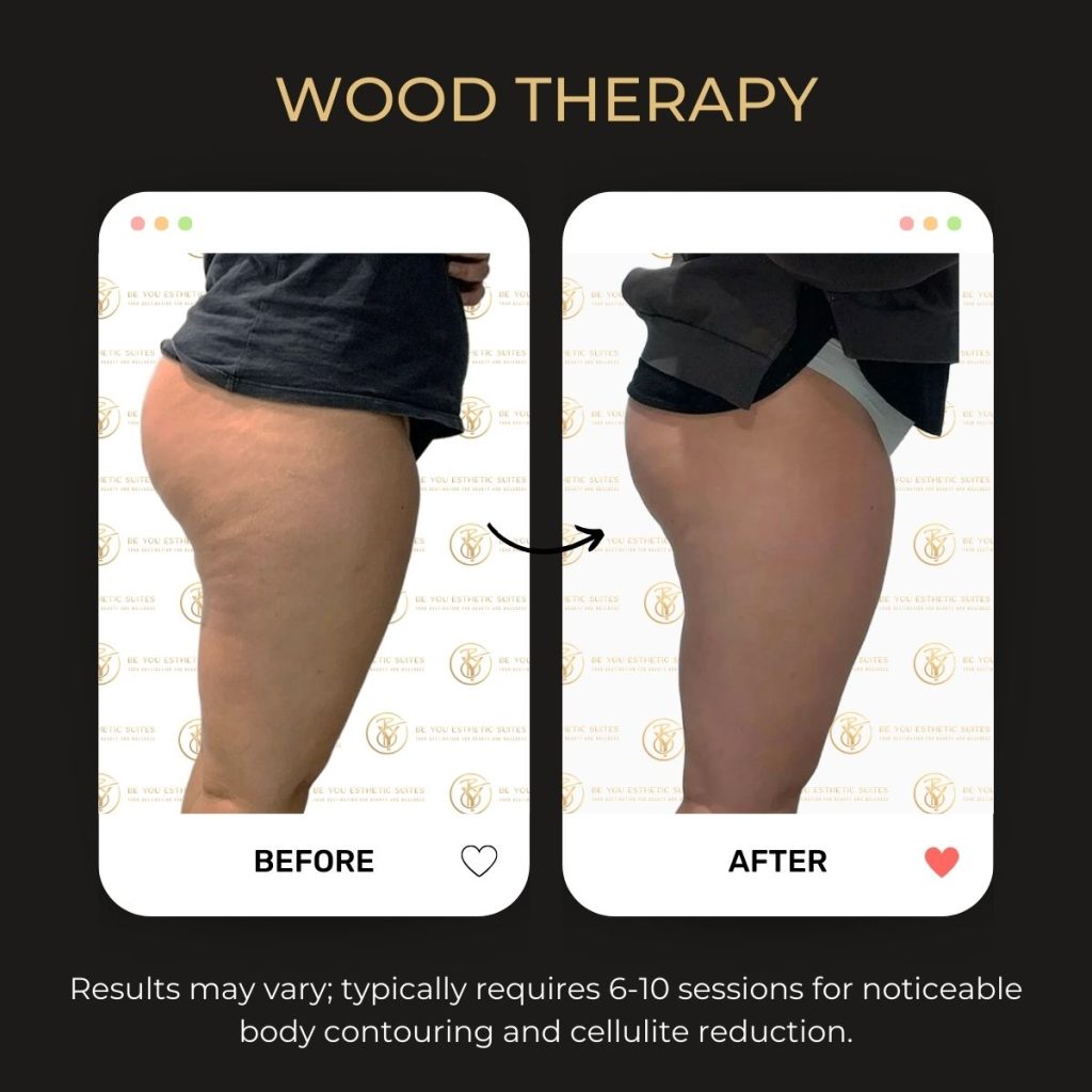 Be You Esthetic Suites is the top rated med spa suites in Brooklyn, offering affordable med spa services in Brooklyn from independent service providers. Post surgery healing services like lymphatic drainage massage near Park Slope, red light therapy in Brooklyn, and more to help you recover from your surgery quickly. They do also offer Brooklyn body sculpting treatments like ultrasonic cavitation in Brooklyn, wood therapy massage near Park Slope, and weight loss treatments in Brooklyn like Semaglutide and Tirzepatide. chemical peels in Brooklyn, acne treatments in Brooklyn, microdermabrasion near Park Slope, laser hair removal in Brooklyn, Brooklyn lip fillers, body fillers in Brooklyn, Brooklyn laser hair removal, laser hair near Park slope, microneedling in brooklyn, waxing in brooklyn. Post-BBL Massage, circulation improvement, fat survival, contour maintenance