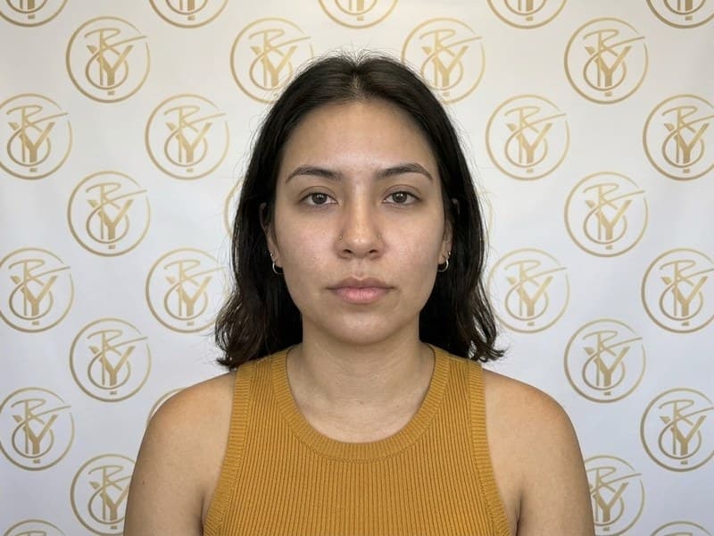 Acne Treatment — after