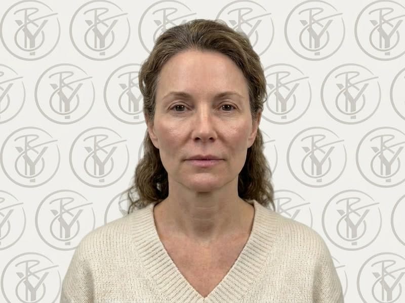 Dermal Fillers — after