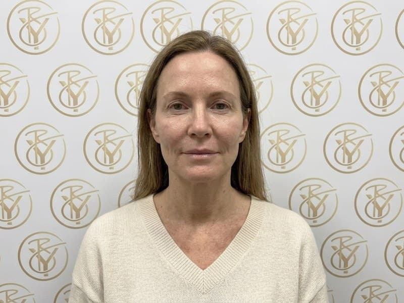 Dermal Fillers — after