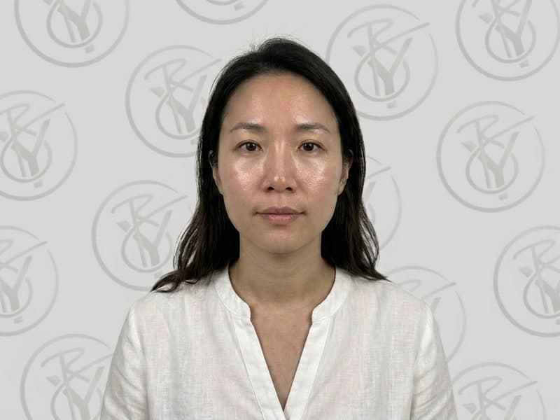 Chemical Peel — after