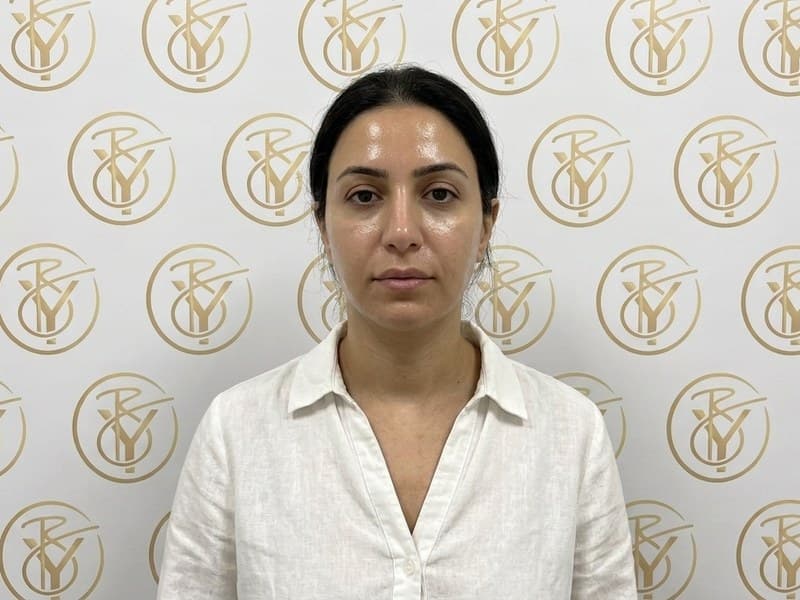 Microdermabrasion — after