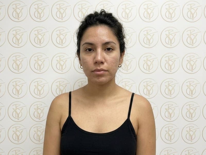 Microneedling — after