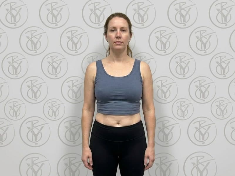 Ultrasonic Cavitation — after
