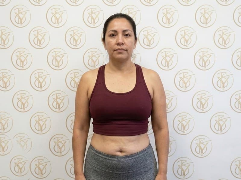 Ultrasonic Cavitation — after