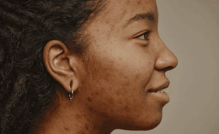 Acne scarring making you self-conscious.