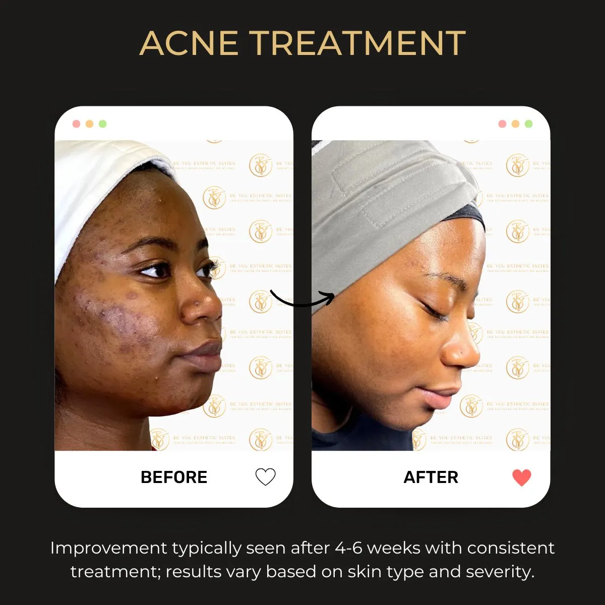 Before and after acne treatment at Be You Esthetic Suites.