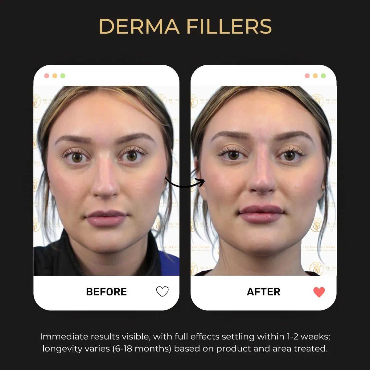 Derma Fillers before and after — Be You Esthetic Suites.