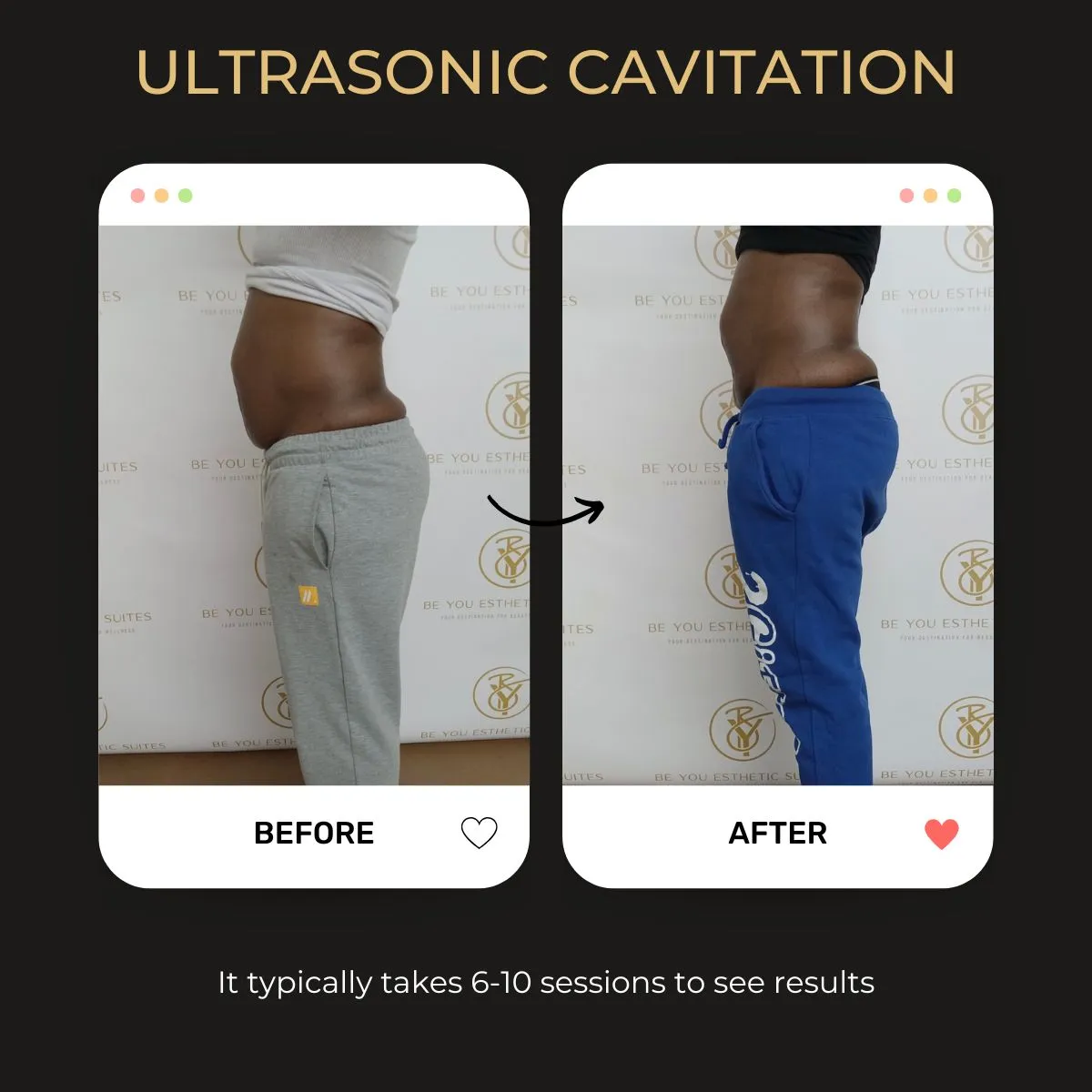 Ultrasonic cavitation before and after — Be You Esthetic Suites.