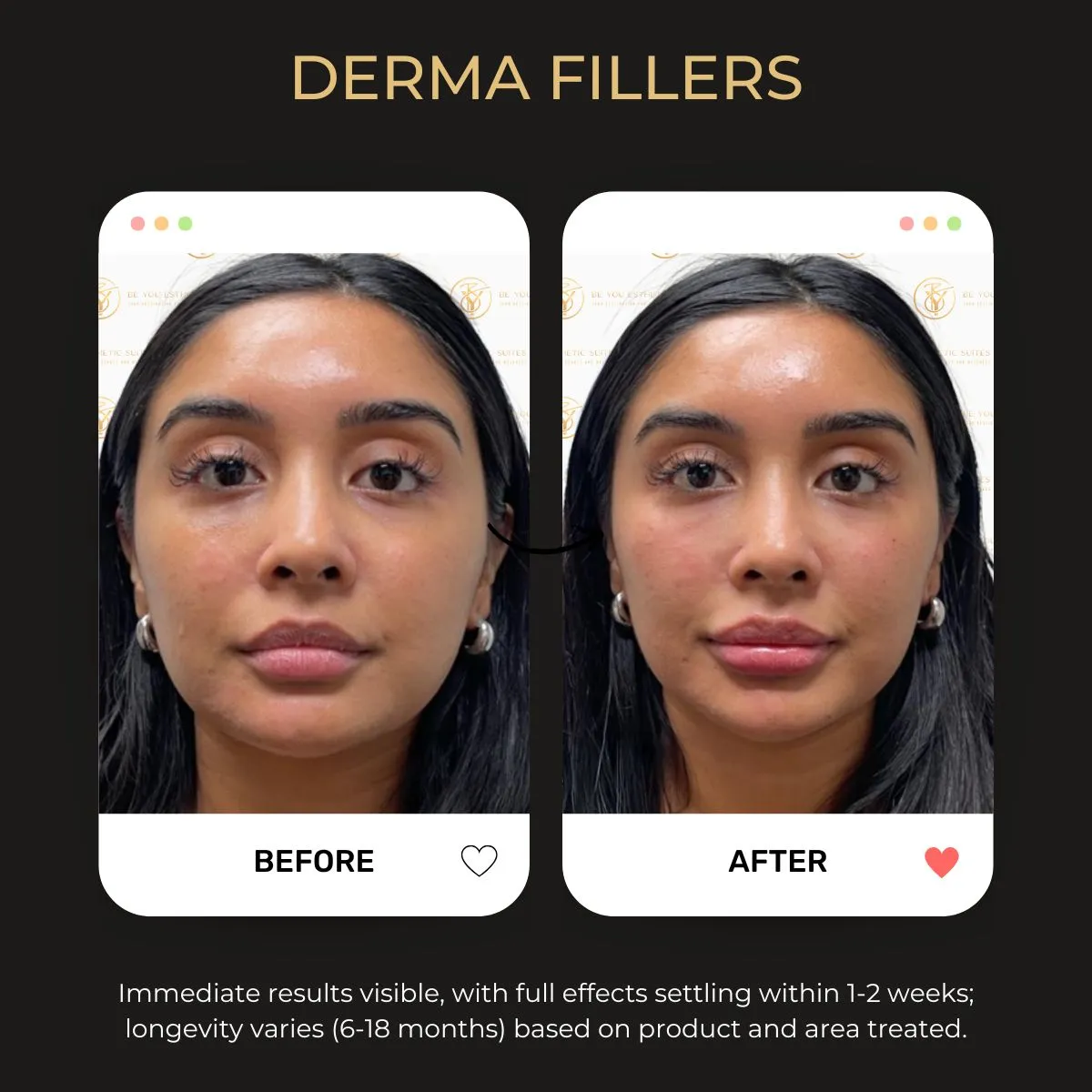 Body fillers before/after example 3.