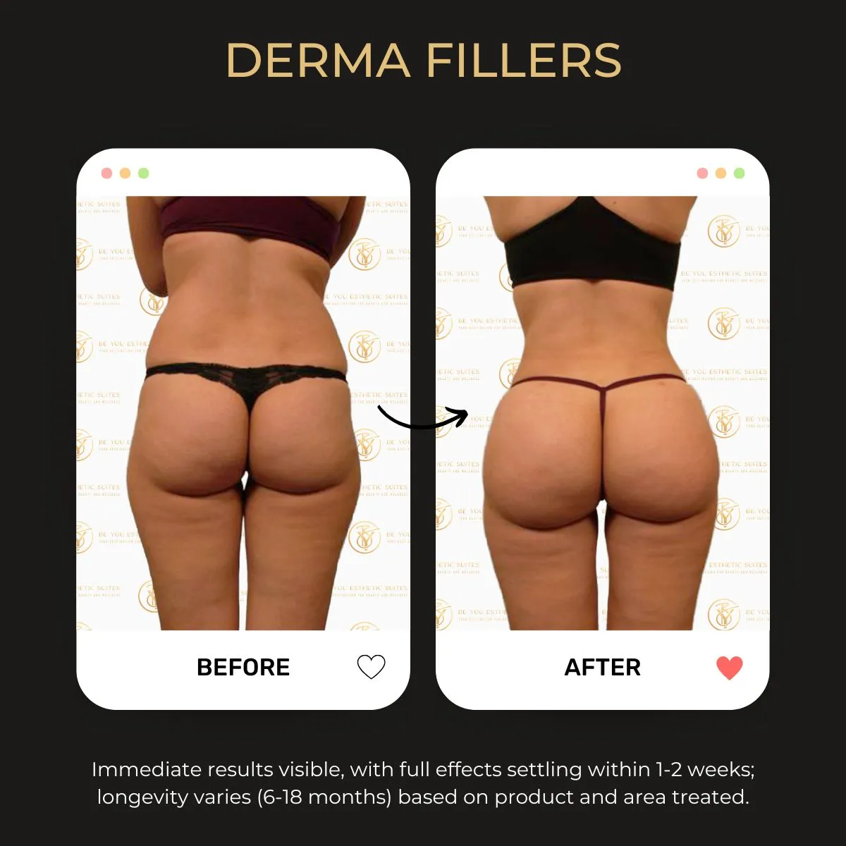 Body fillers before/after example 4.
