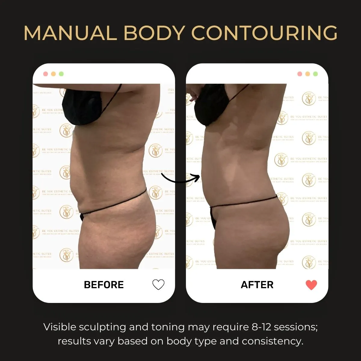 Before and after manual body contouring results at Be You Esthetic Suites in Brooklyn, NY.