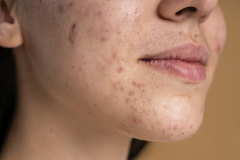 Skin texture, fine lines, and acne scars — microneedling.