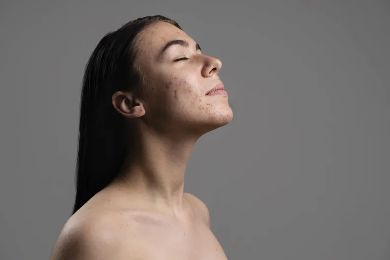 Dark spots and dull skin — microneedling.