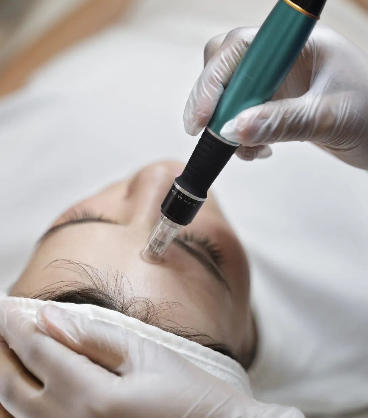 Microneedling treatment at Be You Esthetic Suites.