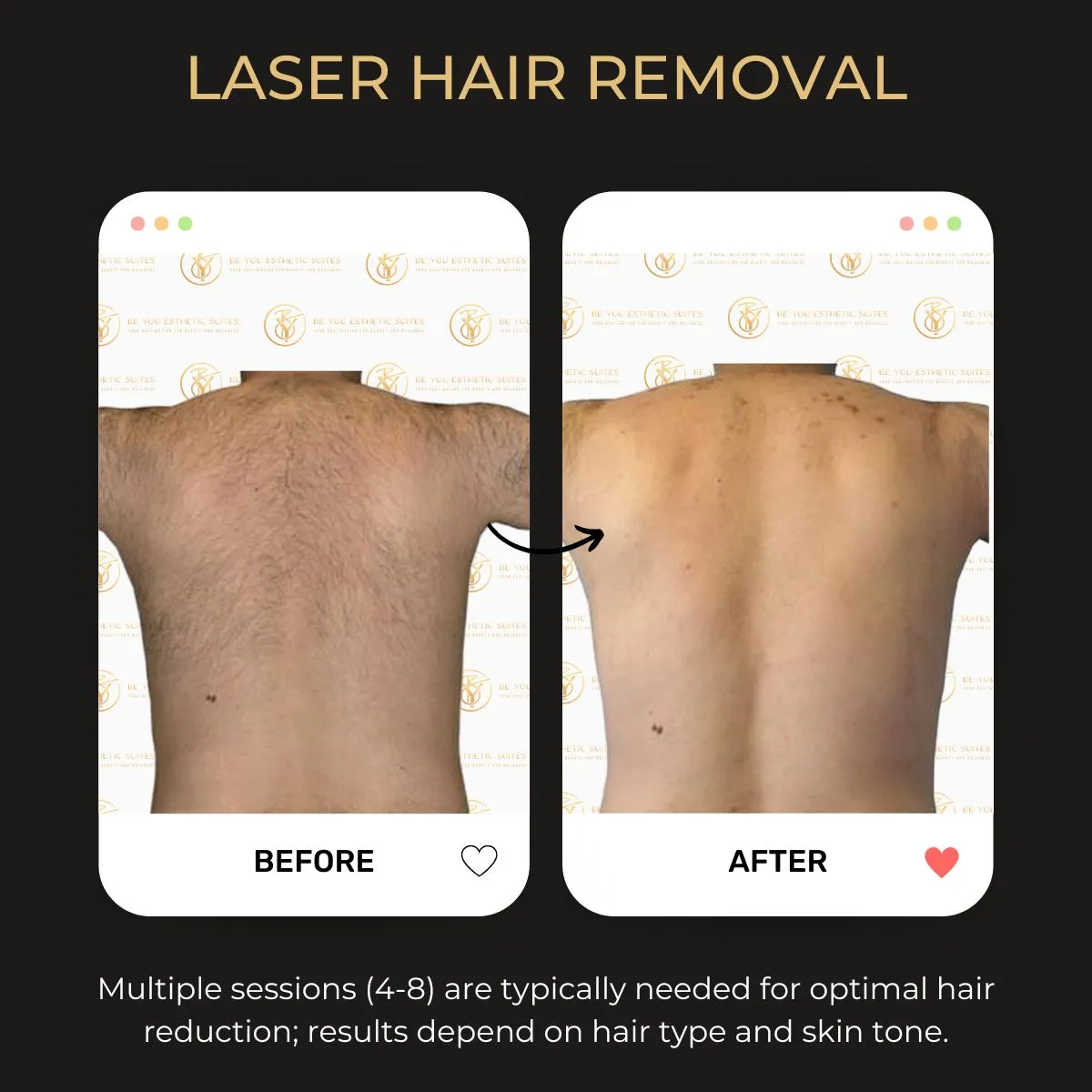 Before and after laser hair removal results on the back at Be You Esthetic Suites.