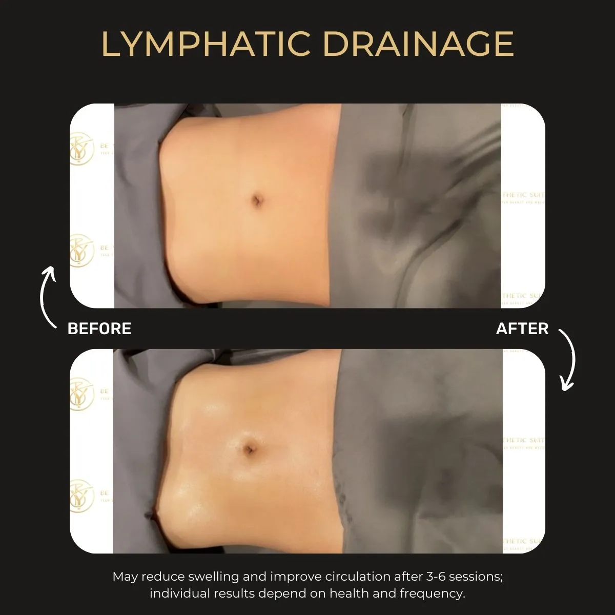 Before and after lymphatic drainage treatment results at Be You Esthetic Suites.