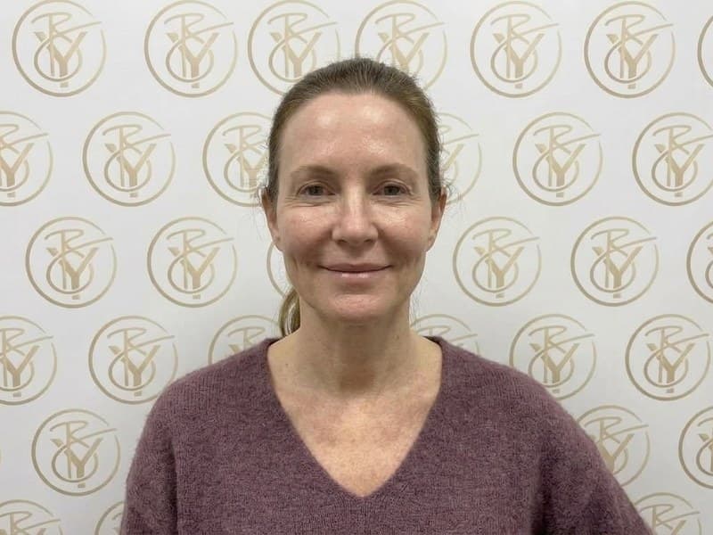 Dermal Fillers — after