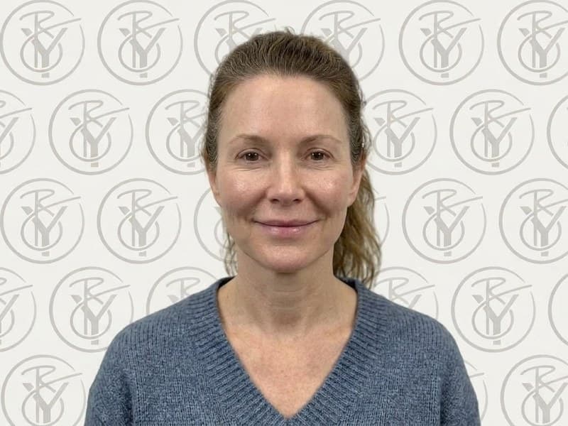 Dermal Fillers — after