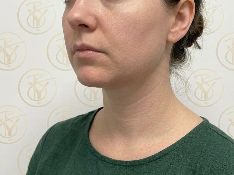 Kybella — after