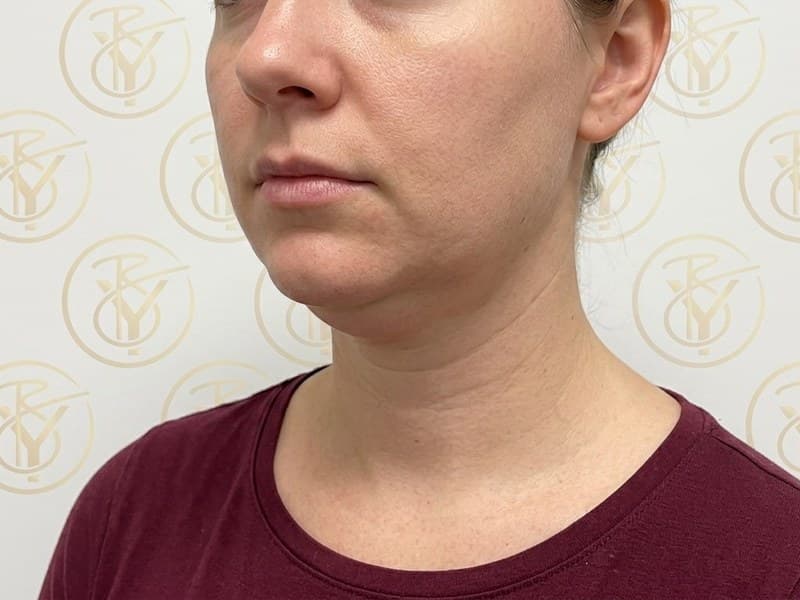 Kybella — before