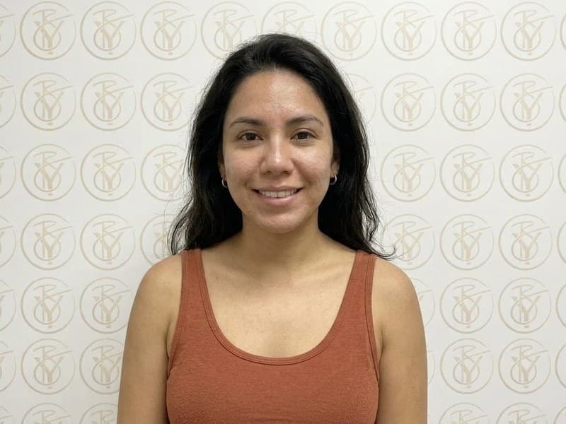 Microneedling — after