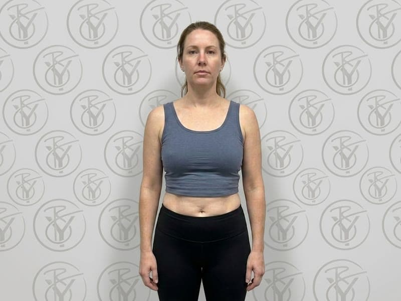 After — No Surgery Needed at Be You Esthetic Suites