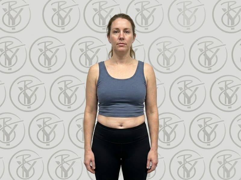 Before — No Surgery Needed at Be You Esthetic Suites