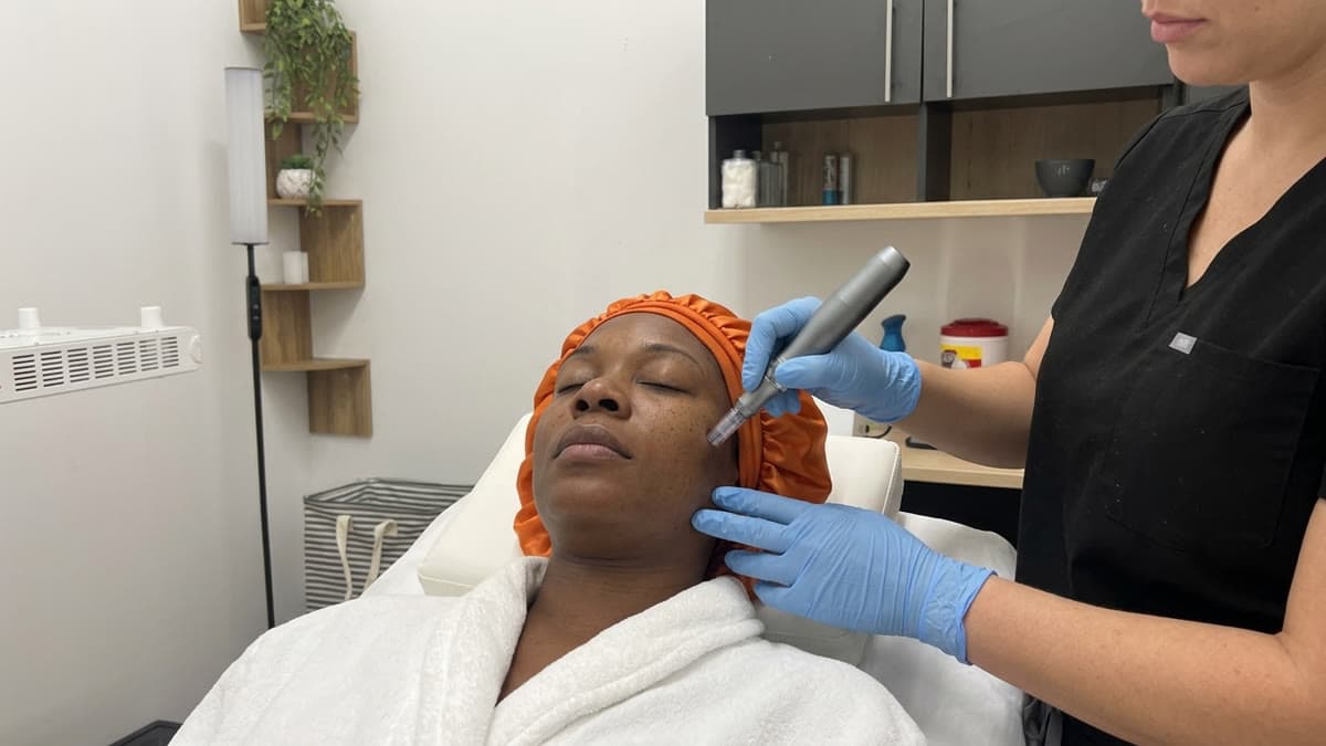 Before and after microneedling at Be You Esthetic Suites.