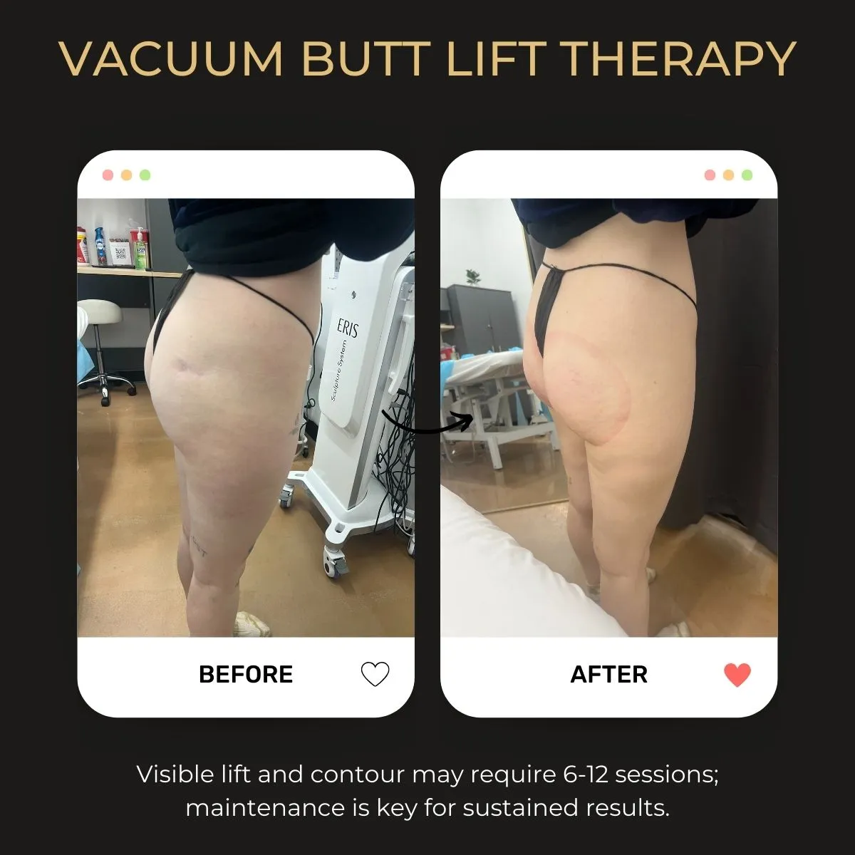 Before and after Vacuum Butt Lift Therapy results at Be You Esthetic Suites.