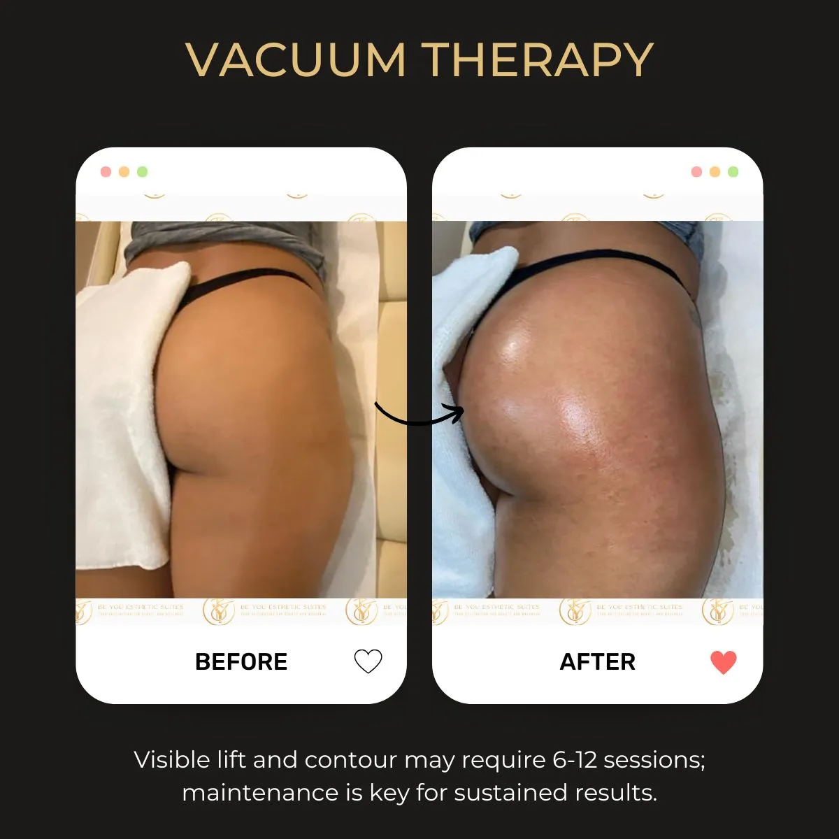 Body Fillers for Curves: Everything You Need to Know About Non-Surgical Enhancement — Be You Esthetic Suites Brooklyn