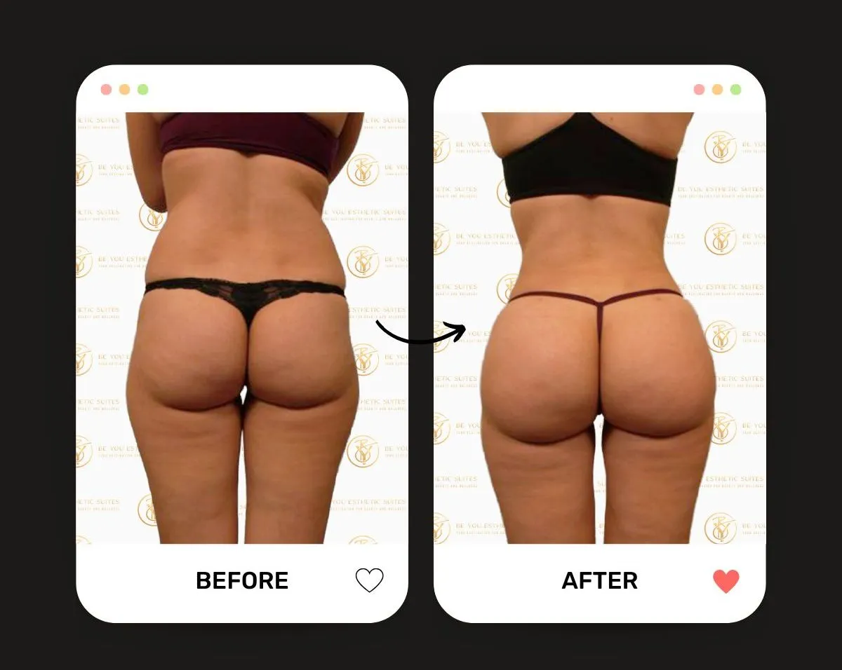 Body Fillers vs. Traditional Surgery: What Brooklyn Residents Need to Know — Be You Esthetic Suites Brooklyn